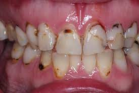 soda and acid erosion on teeth