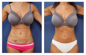 tummy tuck recovery cosmetic plastic