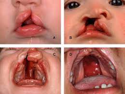 non syndromic cleft lip