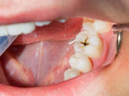 what is tooth decay and cavity home
