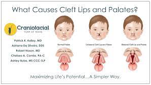 what causes cleft lips and palates
