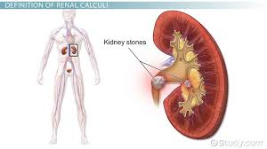 What Are Renal Calculi Definition Causes Symptoms Treatment