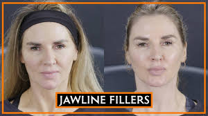 Alibaba.com offers 2,033 jawline filler products. How The Jawline Can Be Defined With Fillers Youtube