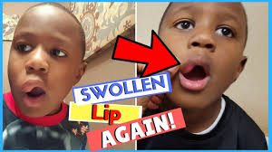 my child has a swollen lip doctors