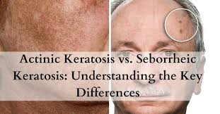 actinic keratosis vs seborrheic keratosis