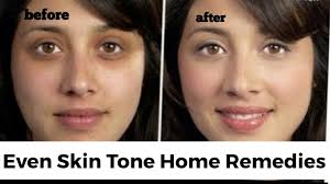 There are 110 uneven skin tone for sale on etsy, and they cost £33.92 on average. Home Remedies For Uneven Skin Tone For All Skin Types All Skin Problems To Be Solved Youtube