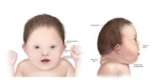 Down syndrome can usually be diagnosed at birth because of the distinctive phenotype. Chromosomal Abnormalities Trisomy 21 Down Syndrome Ncbddd Cdc