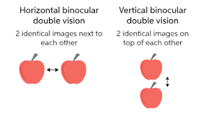 Learn About Double-Vision | Chegg.com