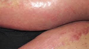Hsv infection may begin with itching, which is a sub. Psoriasis Vs Herpes What S The Difference