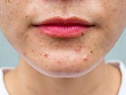 how to get rid of acne 14 home
