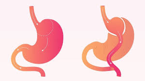 how long does gastric byp surgery
