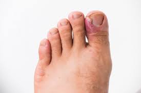 is your ingrown toenail oozing clear or