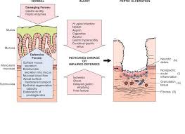 Pathology Ii Pathophysiology Of Peptic Ulcer