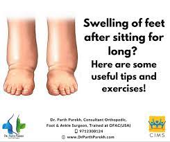 swelling of feet after sitting for long