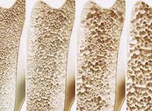 Est-ce que l'ostéoporose fatigue ?