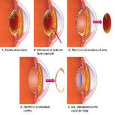 eye care cataract surgery progress