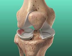 meniscus injury torn knee cartilage