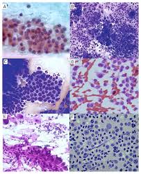 Carcinoma, bethesda system, thyroid, fine needle aspiration, sensitivity, specificity, prognostic value. Cytomorphological Patterns Of Thyroid Lesions Among F1000research