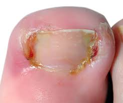 nail disorders refhelp