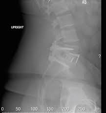 cureus acute lumbar schmorl s node