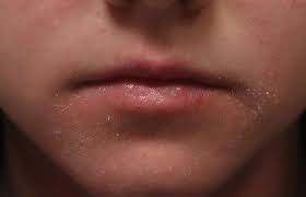 eczema on lips causes treatment