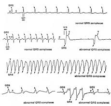 Ekg Interpretation