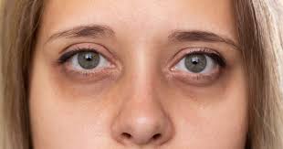 how long after eyelid surgery can you