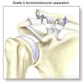 Image result for icd-10 code for grade 1 ac joint separation left