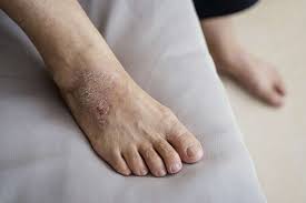 feet eczema treatment triggers and