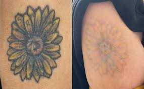 fotona tattoo removal treatment