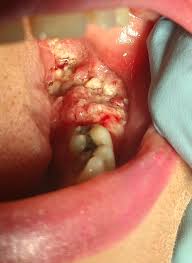 who is extracting your tooth part 2