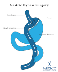 gastric byp surgery complications