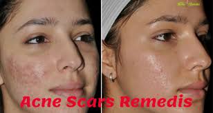 11 top home remes to remove acne scars