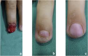 fingernail injury in children