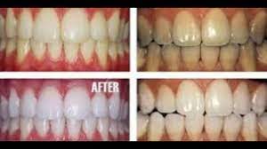 Just dip a damp toothbrush in. Diy Teeth Whitening At Home With Baking Soda You Will Not Believe The Results Youtube