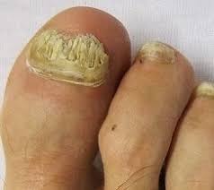 thick toenails diagnosis treatment