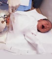 Circumcision In Baby Boys Its Benefits Drawbacks And Care