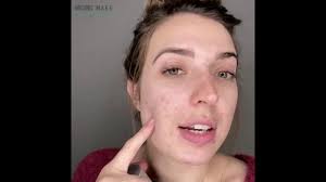 does talc in makeup cause acne