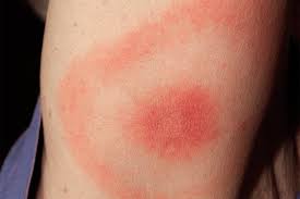 lyme disease prevention for the little