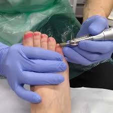 reducing thick nails footman podiatry