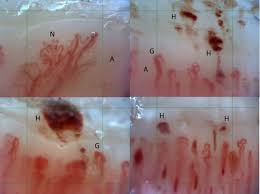 nailfold capillary scleroderma pattern