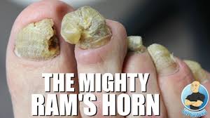 overgrown ram s horn toenail removal
