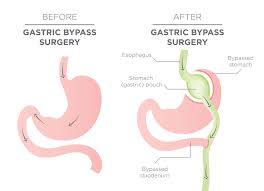 your stomach after gastric byp
