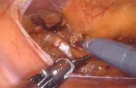 robotic bilateral inguinal hernia