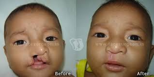 cleft lip surgery at best in