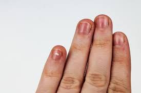 red lines on fingernails causes
