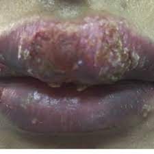 lips showing upper lip swelling