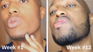 Do not stop at once. Minoxidil Beard Journey 3 Month Transformation Youtube
