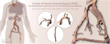 a case of a femoro fem byp ffb