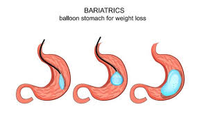 revision bariatric surgery sleeve center